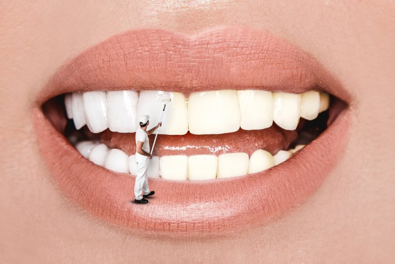 הלבנת שיניים בתל אביב: הכירו את גט סמייל. צילום: MarcinK3333, Shutterstock