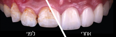 ציפוי שיניים מקצועי. צילום: Les Expert